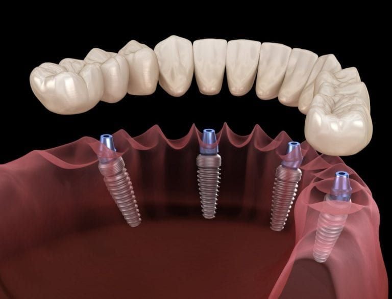 Full Mouth Restoration Keppel Advanced Dentistry