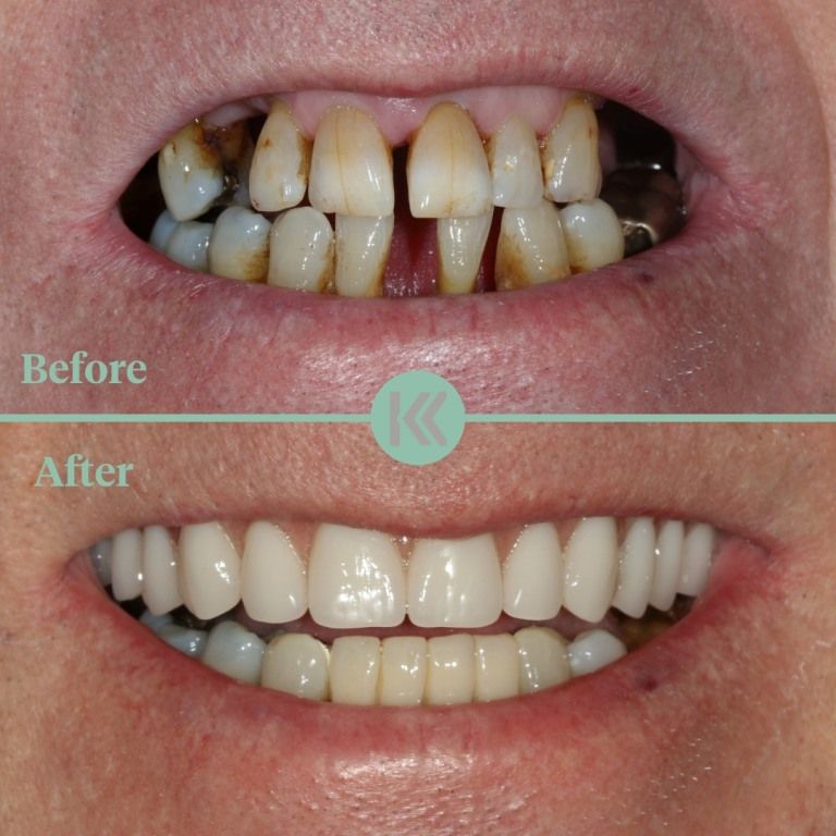 Before and after treatment at Keppel Dentistry