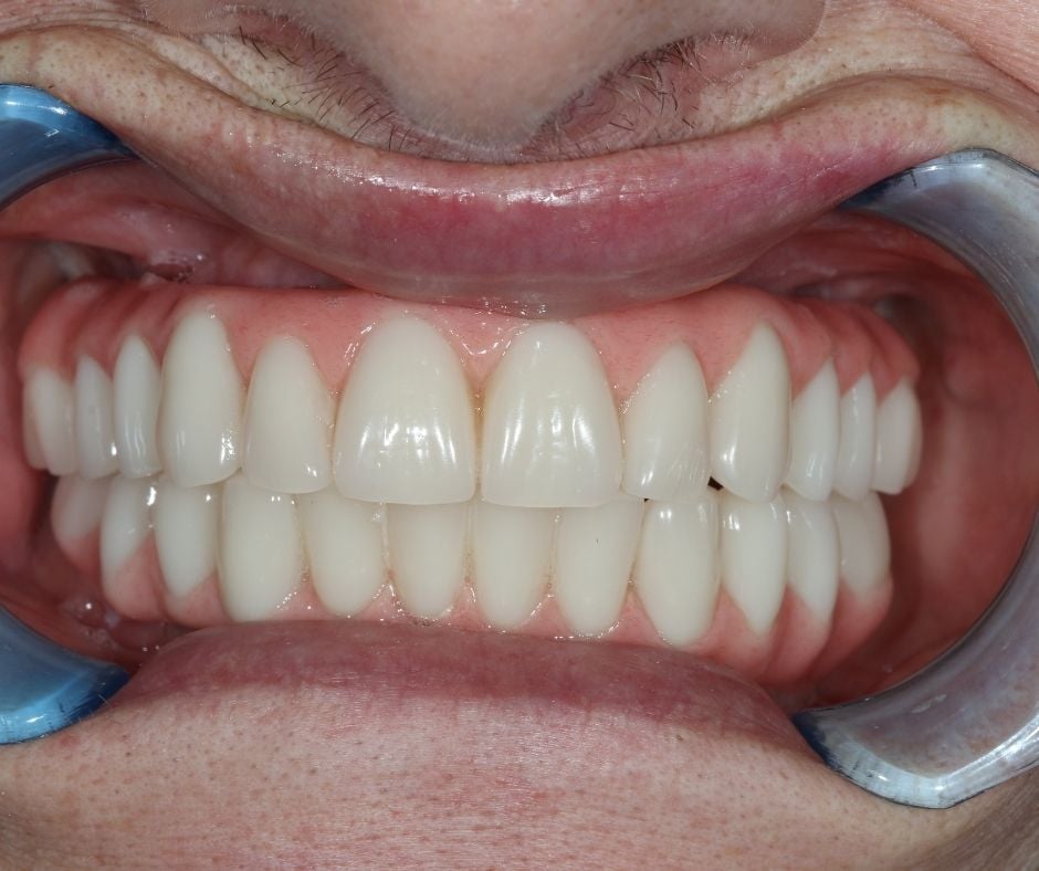 Full Mouth Restoration Keppel Advanced Dentistry