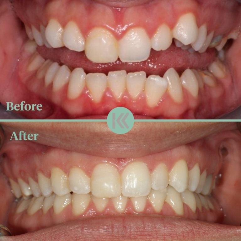 Before and after treatment at Keppel Dentistry